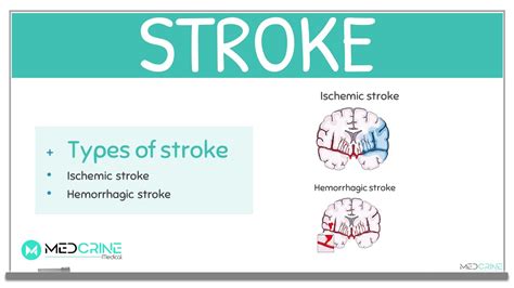 stroke definition svenska